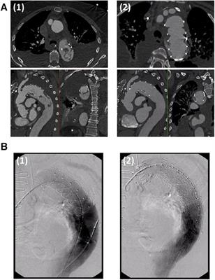 Risk factors, prevention, and therapy of intraluminal stent thrombosis in frozen elephant trunk prostheses—what we know so far